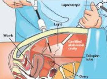 Gynecology Surgery